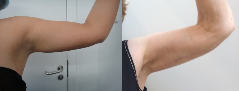Getting Rid of Arm Fat