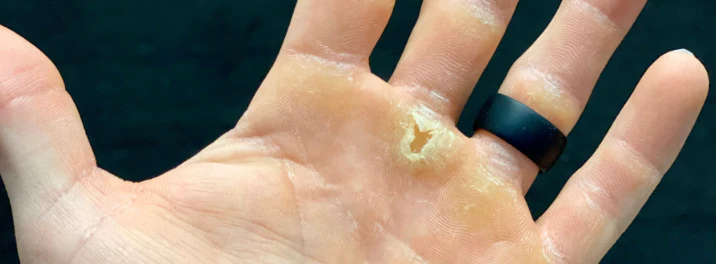 Mastering Callus Care