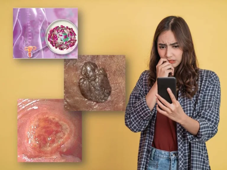 Blue Waffle Disease